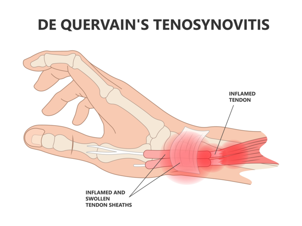 Condition Spotlight De Quervain’s Tenosynovitis by Amy Eckert