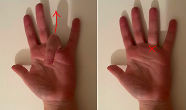 Trigger finger - Symptoms and causes - Mayo Clinic