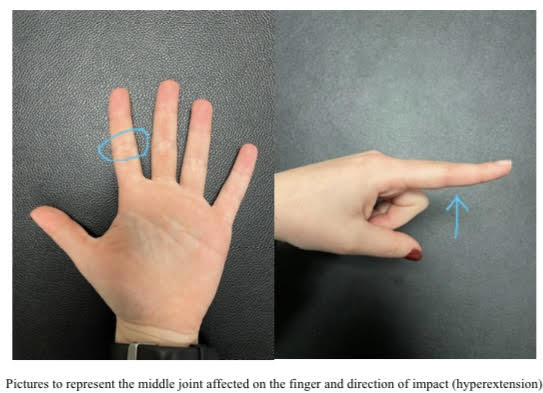 Hyperextended Hand