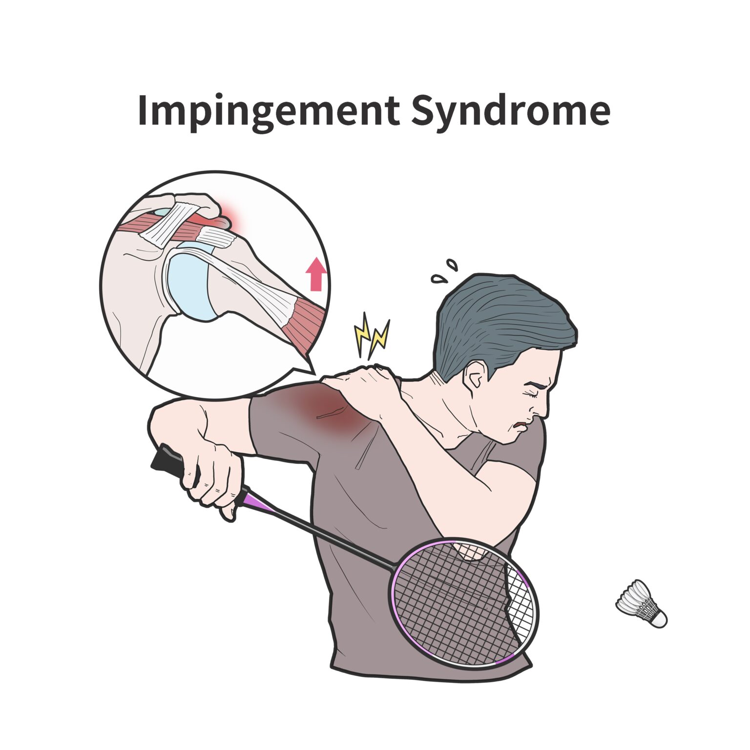 Condition Spotlight Shoulder Impingement By Amy Eckert Occupational Therapist Doctoral